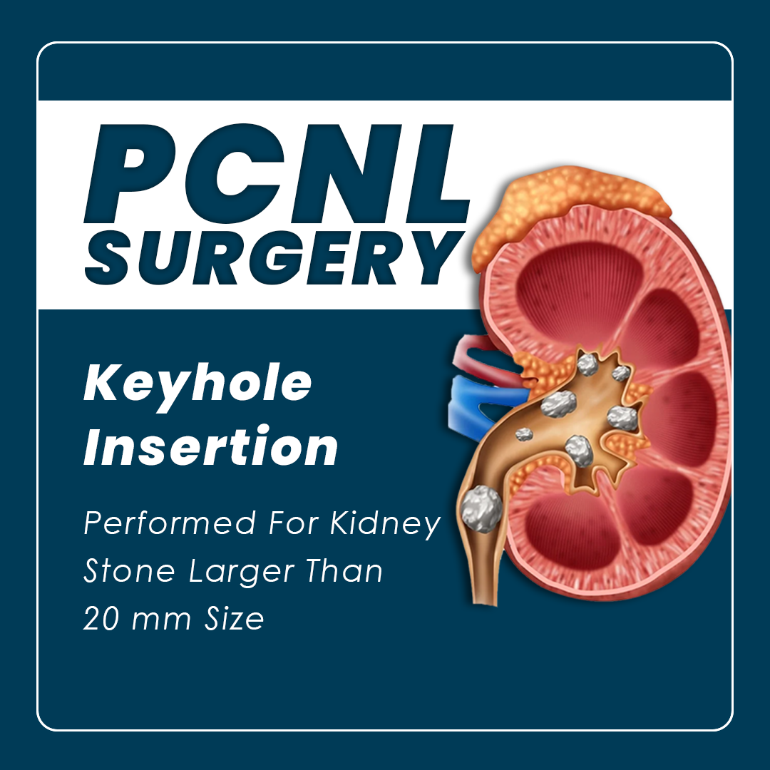 pcnl